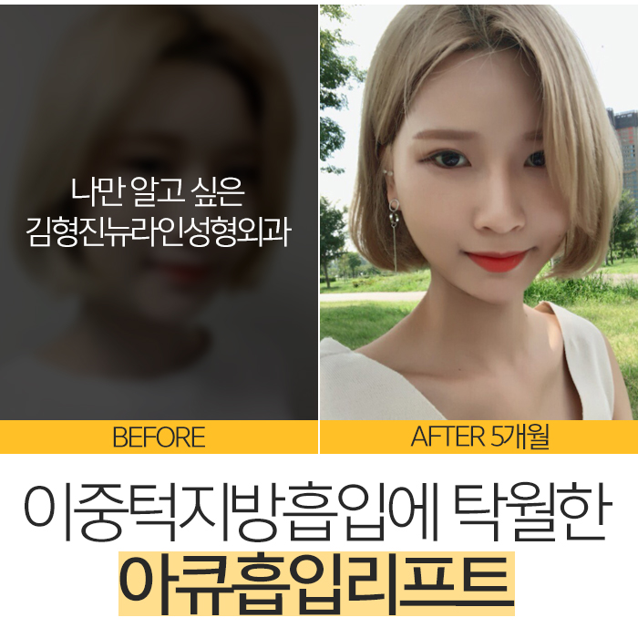 이중턱지방흡입부작용 걱정 없는데 관련 이미지 6