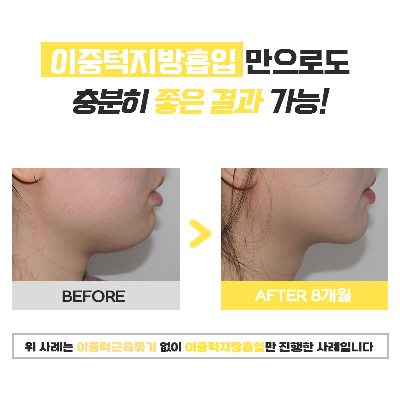 이중턱수술로 턱살부터 탄력까지 완벽하게 개선했어요! 관련 이미지 6