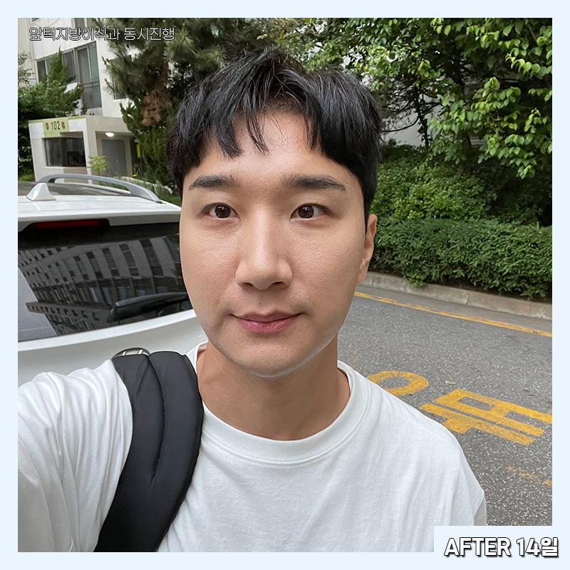 남자심부볼제거 가능하냐구요? 당연하죠! 관련 이미지 4