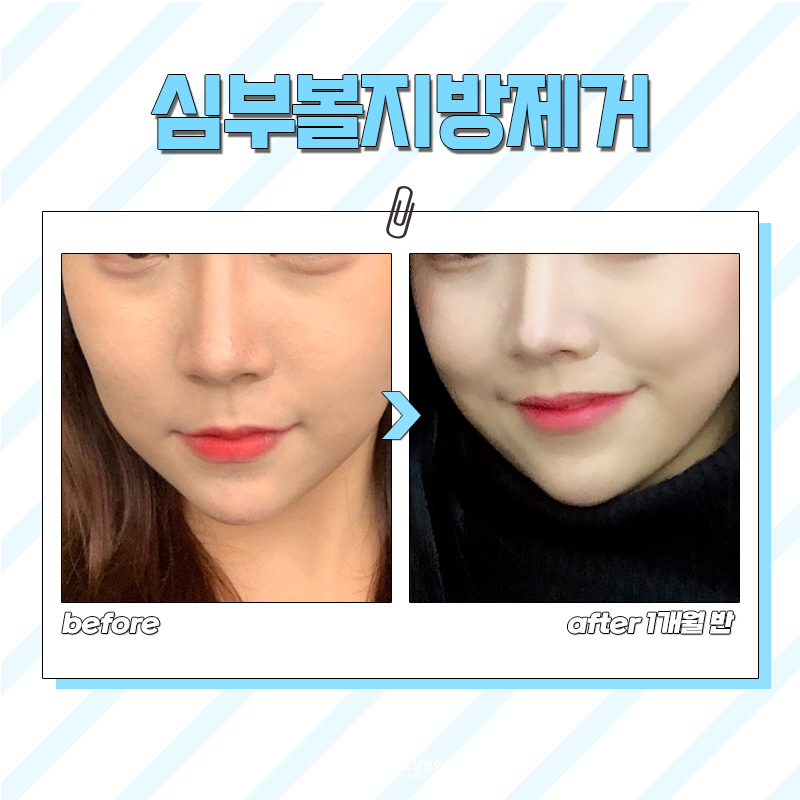 볼살만 빠지지 않는 이유! 심부볼지방없애는법은 따로 있어요 관련 이미지 5