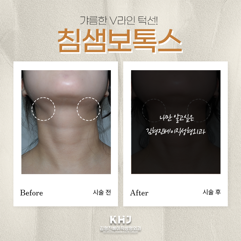 침샘비대증치료 김형진베이직에서 하셔야죠! 관련 이미지 5