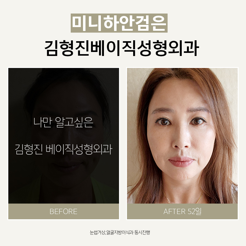 미니하안검 너무 괜찮죠? 관련 이미지 6