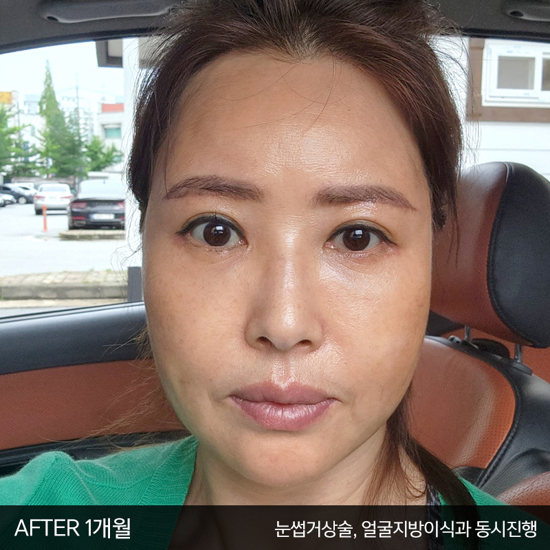 중년눈밑처짐 해결방법은 관련 이미지 5