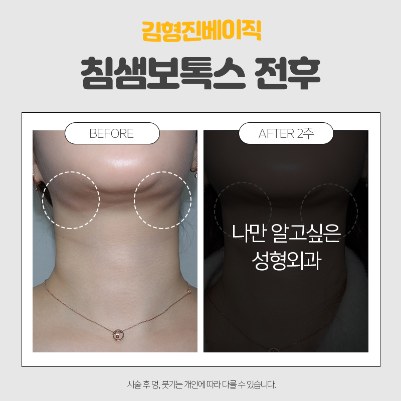 침샘치료를 해야한다면 관련 이미지 2