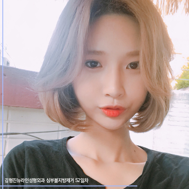 심부볼지방제거 관련 이미지 4