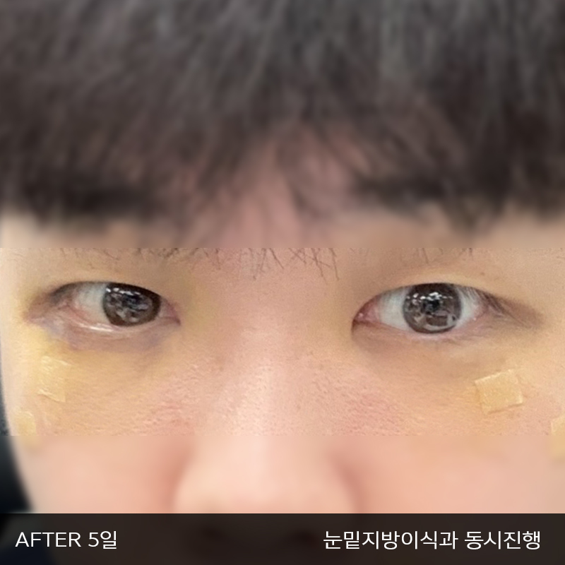 눈밑지방재배치수술이 궁금하시다면 관련 이미지 4