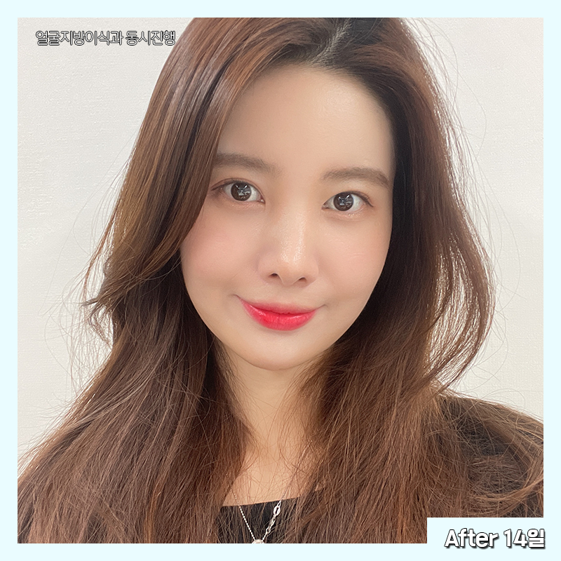 얼굴지흡효과 얼마나 좋냐면요 관련 이미지 5