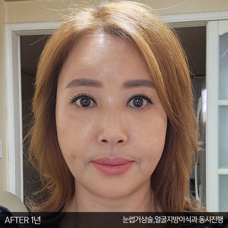 중년눈밑수술 잘하는 김형진베이직 관련 이미지 7