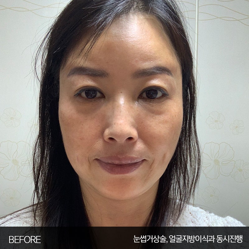 미니하안검수술방법 궁금하시죠? 관련 이미지 2