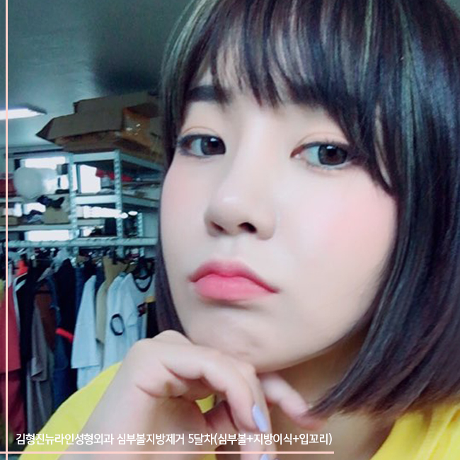 심부볼부작용 김형진뉴라인성형외과에서는 걱정 뚝 관련 이미지 4