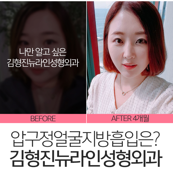 압구정얼굴지방흡입 잘한다고 했죠? 관련 이미지 7