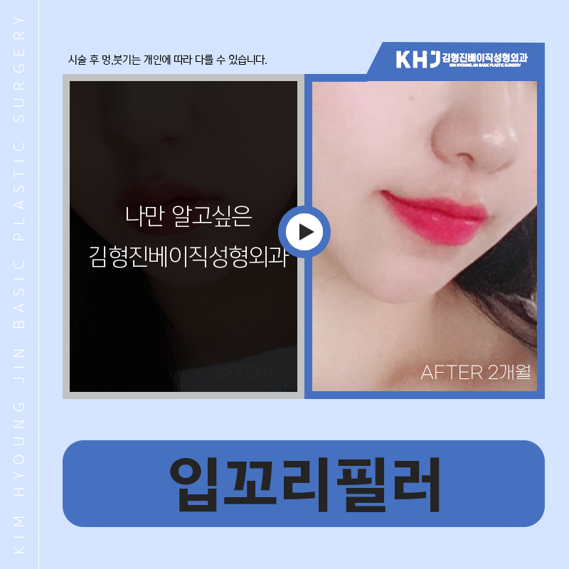 입꼬리필러잘하는곳은 다 이유가 있습니다 관련 이미지 6