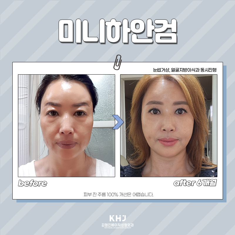 미니하안검절개 후 흉터 걱정은 No No! 관련 이미지 5