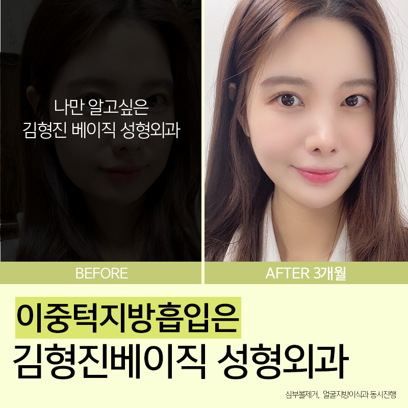 이중턱지방흡입붓기 걱정돼요? 관련 이미지 3
