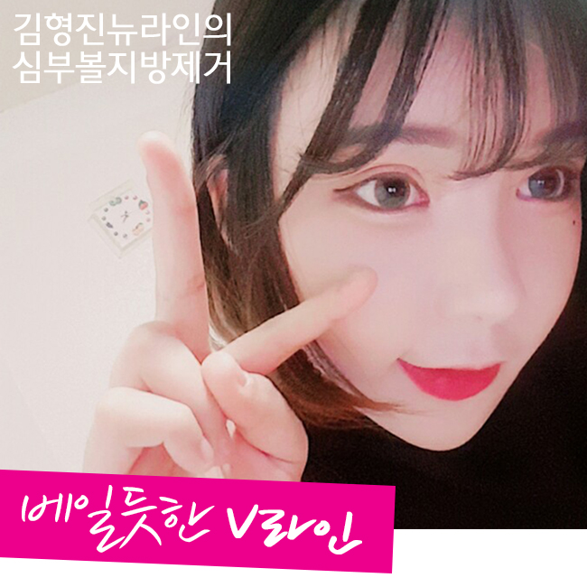 심부볼제거후기 진짜니까 드루와~ 관련 이미지 3