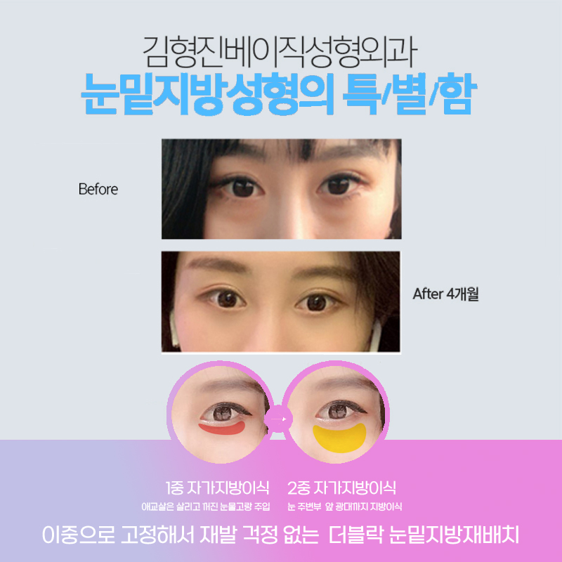 지저분한 눈 밑 지방, 압구정눈밑지로 해결! 관련 이미지 4