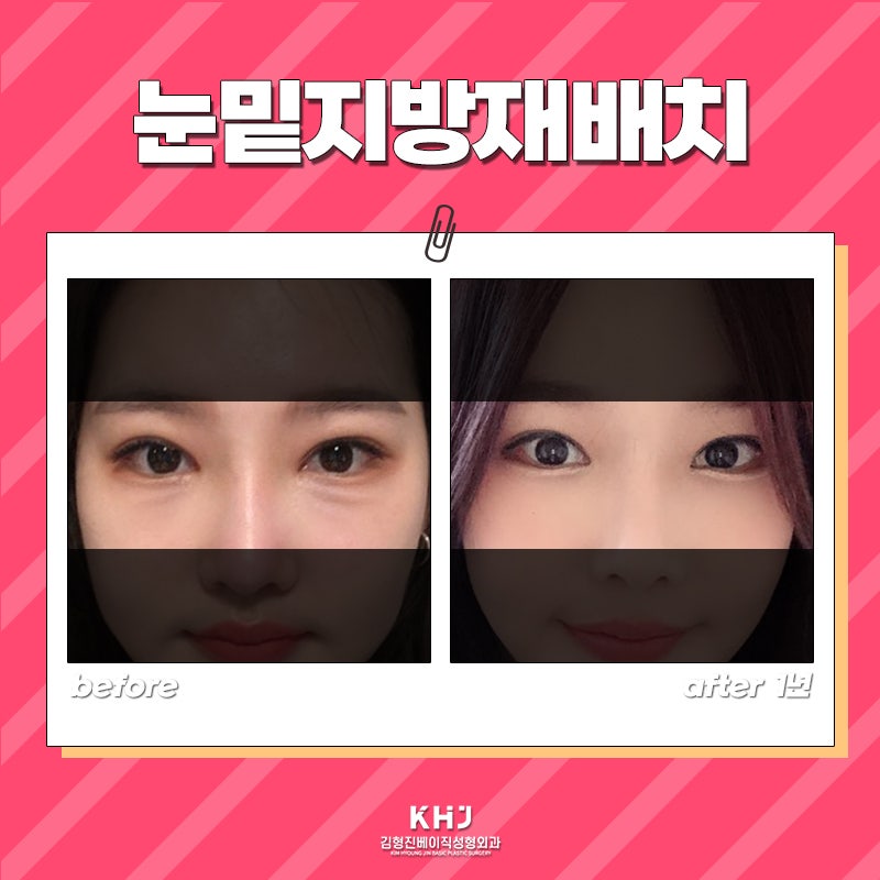 믿을만한 눈밑지방재배치병원 찾고있다면 관련 이미지 6