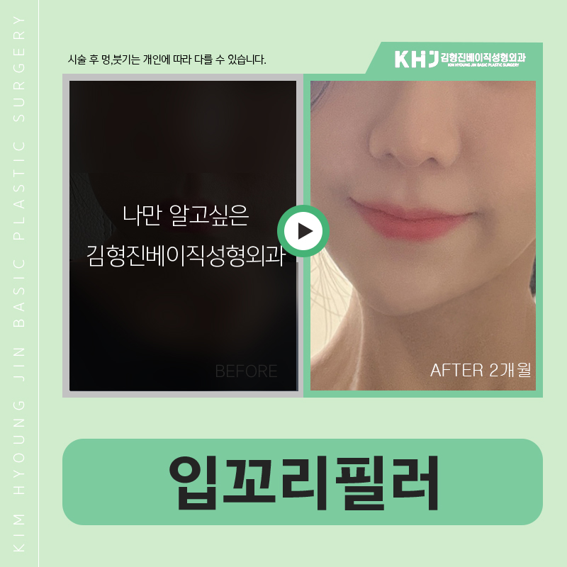 강남입꼬리필러 어디가 잘하는지 모르겠다면 관련 이미지 6
