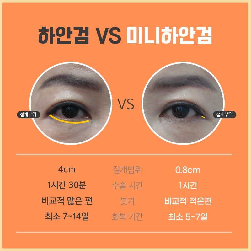 눈 밑 처짐, 미니하안검수술로 이제 가볍게 해결해요 관련 이미지 4