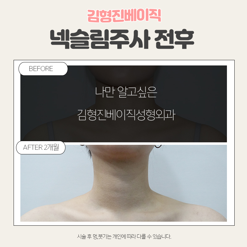 웨딩시술은 김형진베이직에서! 관련 이미지 3