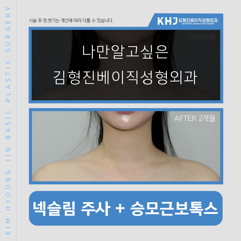 넥슬림보톡스 누가 해야되냐면요 관련 이미지 5