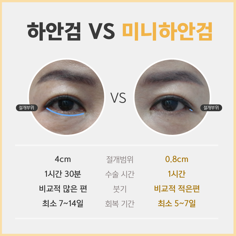 미니하안검흉터 걱정은 이제 그만~! 관련 이미지 5