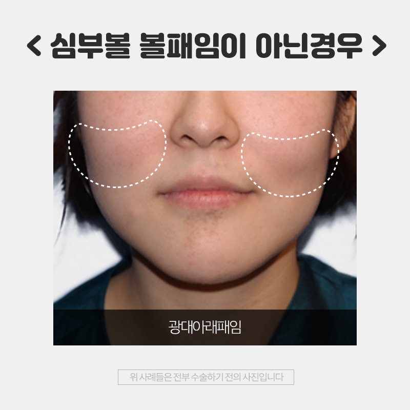 심부볼 볼패임 김형진에서는 걱정 없는 이유! 관련 이미지 5