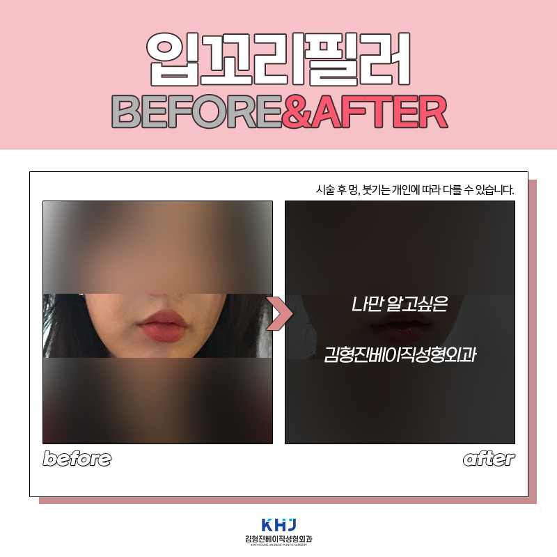 입꼬리필러전후 보고 가실래요? 관련 이미지 5