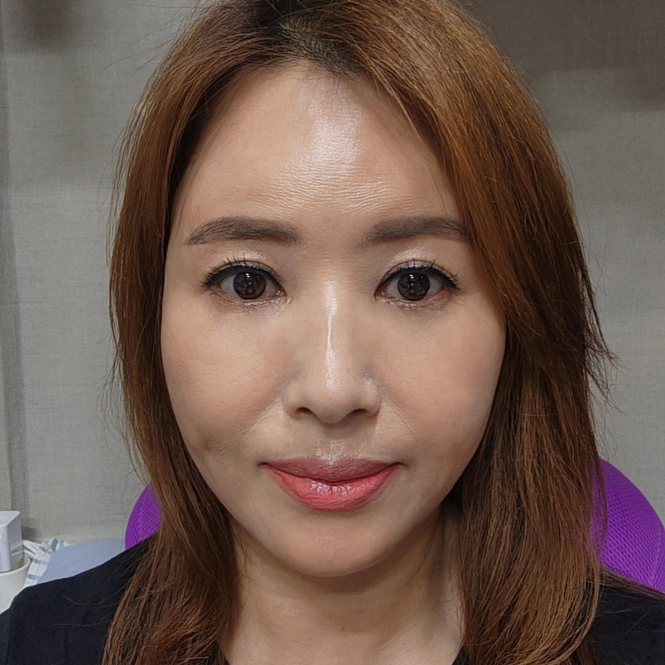 눈밑처짐수술후기 재발 없이 오래 가요 관련 이미지 1