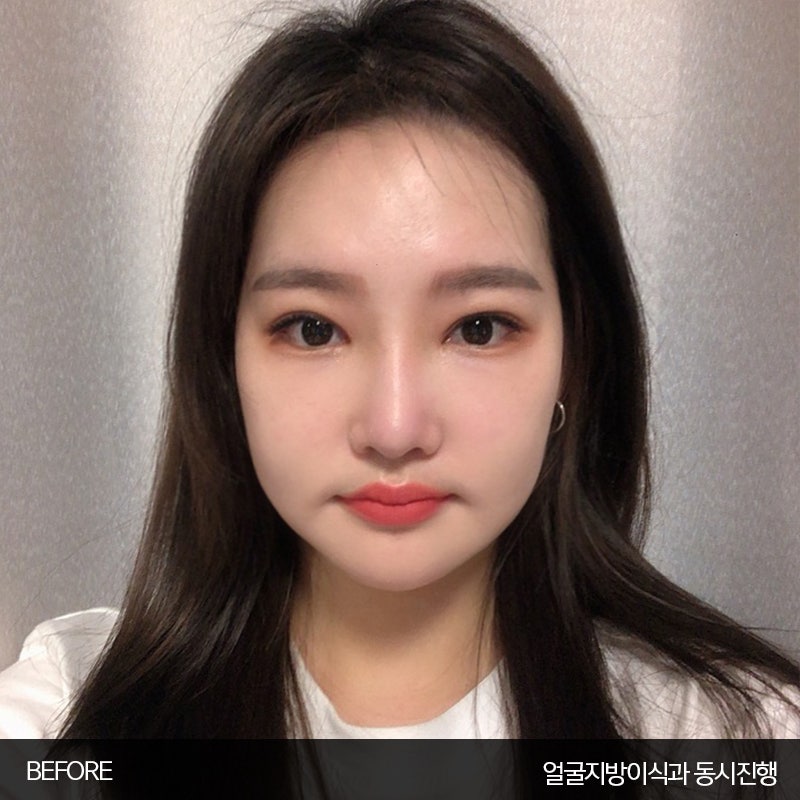 얼굴지흡붓기 김형진베이직은 달라요 관련 이미지 2