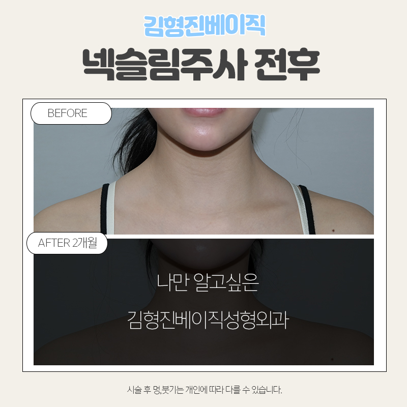 넥슬림주사시술이 궁금하시다면 관련 이미지 6