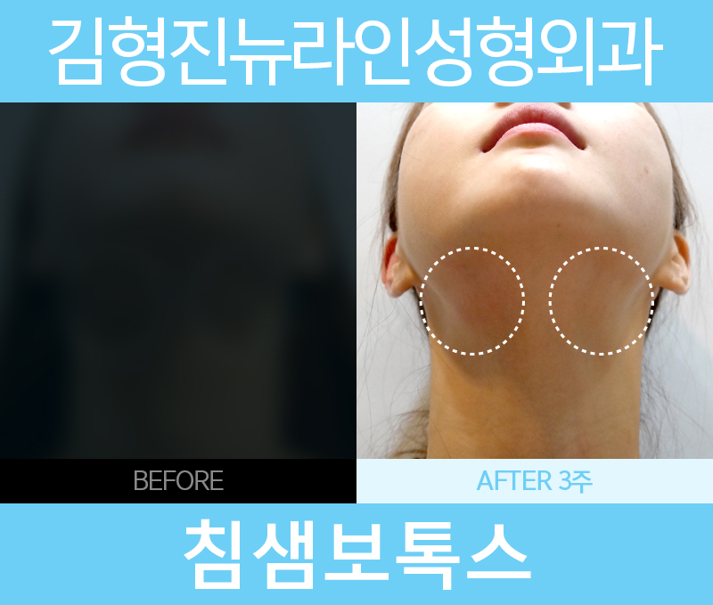 침샘보톡스 확실한 효과를 관련 이미지 5