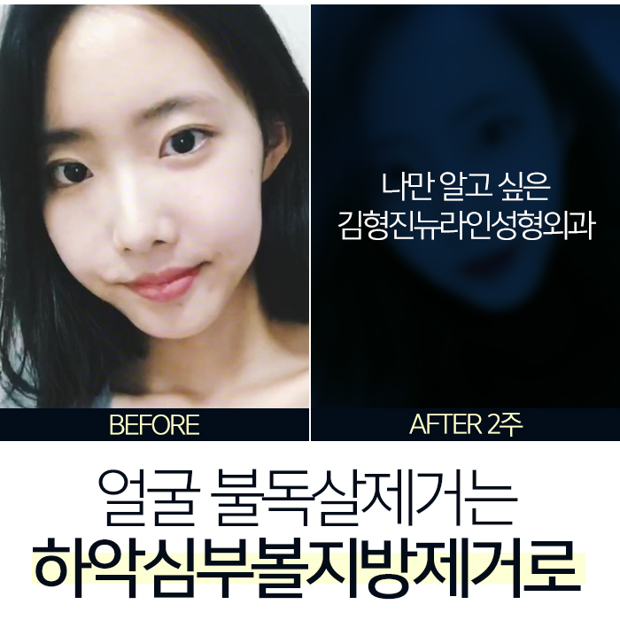 얼굴불독살 없애는방법 따로 있지 관련 이미지 2