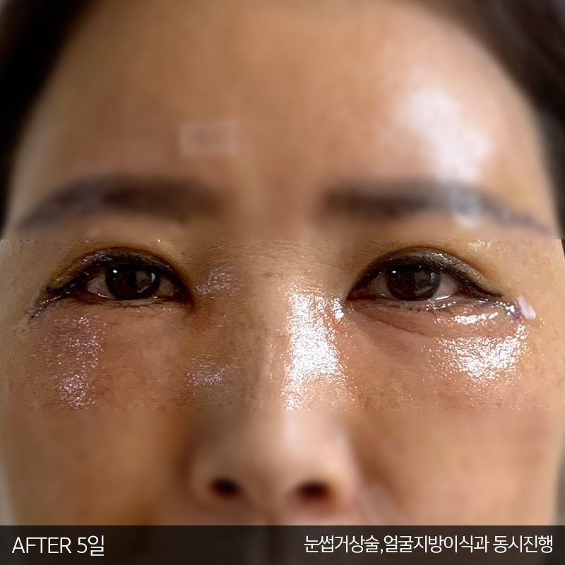 중년눈밑수술 잘하는 김형진베이직 관련 이미지 3