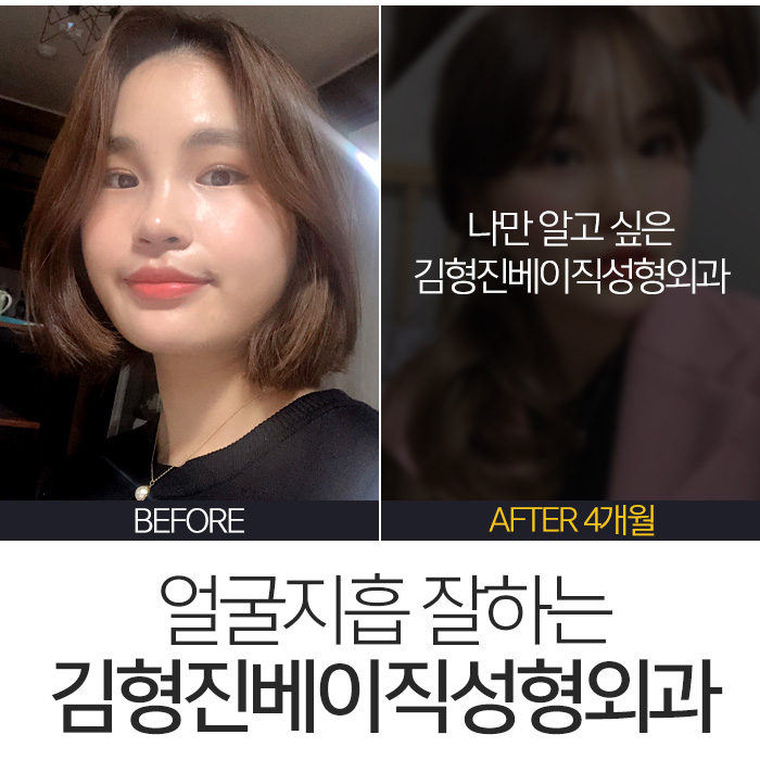 김형진베이직얼굴지흡 얼마나 잘하냐면요 관련 이미지 3