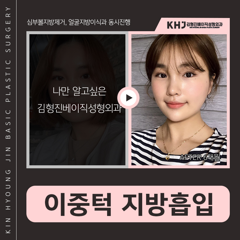 턱라인지방흡입 후기도 좋아 관련 이미지 3