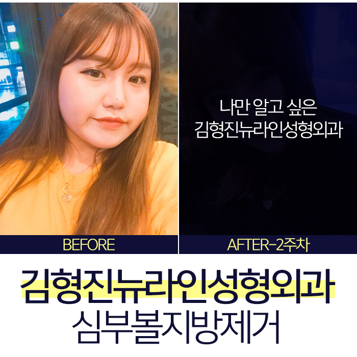 하악심부볼지방제거 수술로 부작용없는 김형진뉴라인성형외과 관련 이미지 7