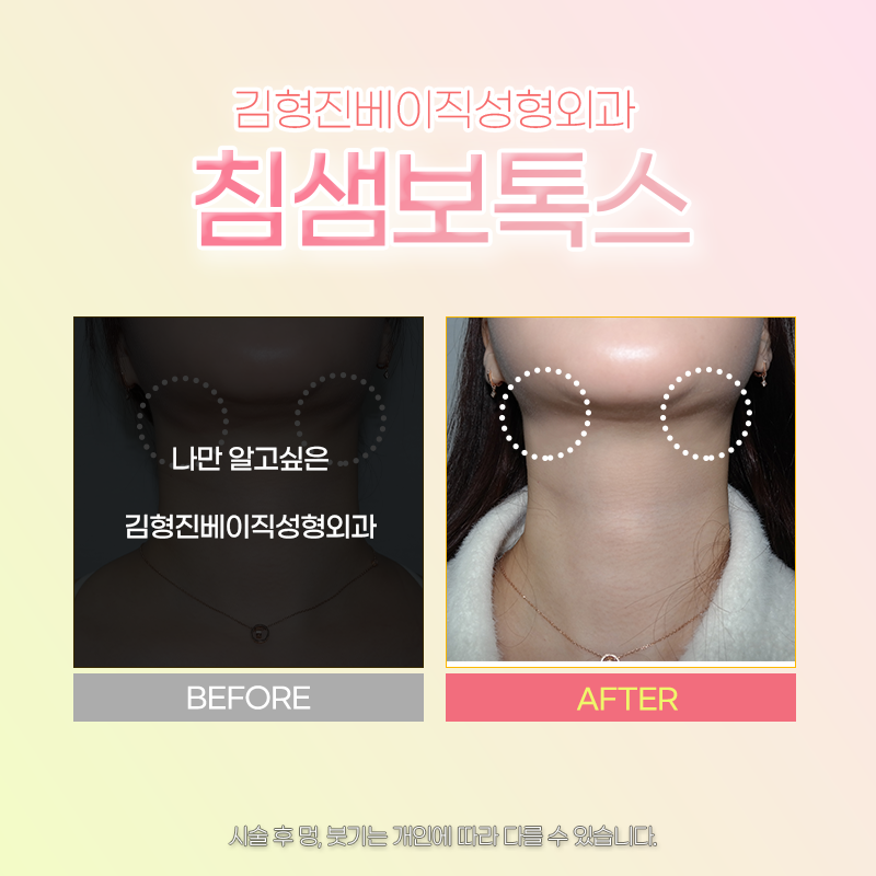 침샘치료 더 이상 미루지 마세요! 관련 이미지 4