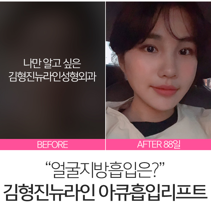 얼굴아큐스컬프 살빼는데 최고죠 관련 이미지 2