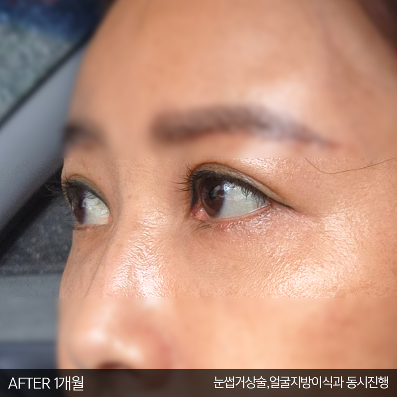 중년눈밑수술 잘하는 김형진베이직 관련 이미지 5