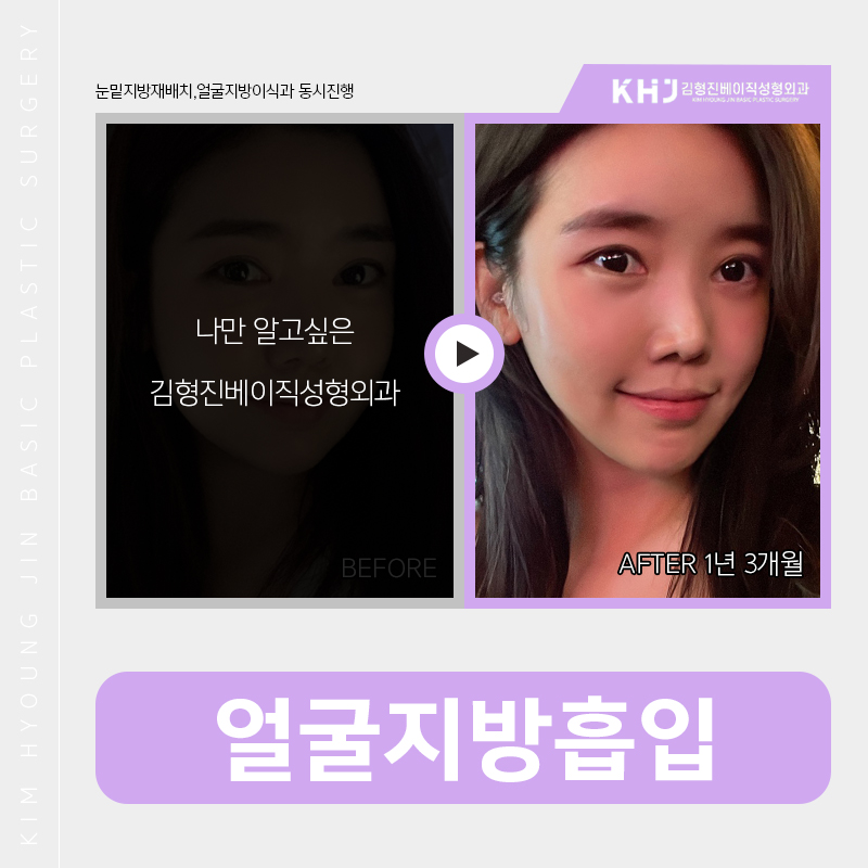 얼굴지방흡입붓기 걱정이시라구요? 관련 이미지 6