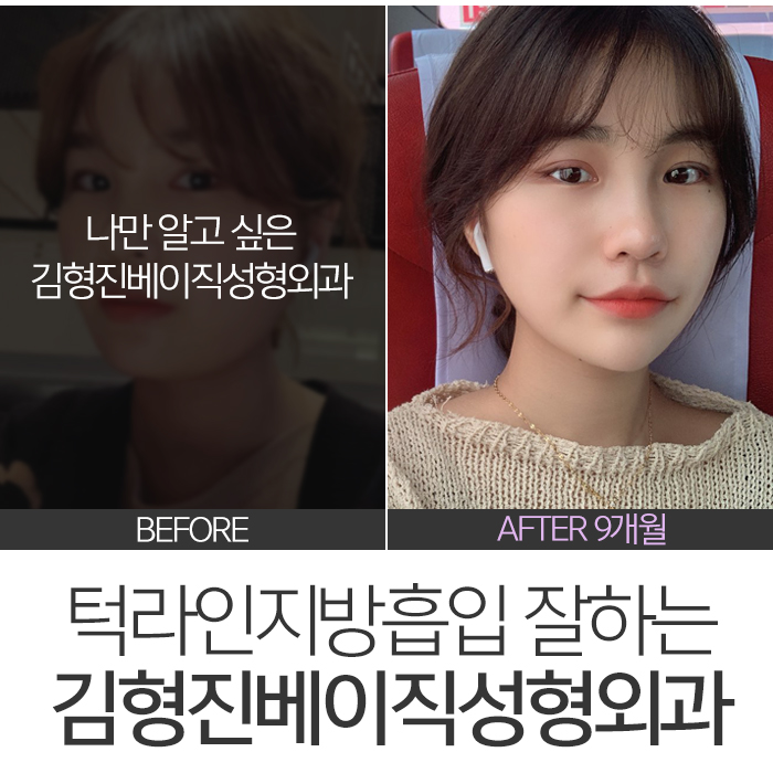 턱라인지방흡입 부담 없는 가격이죠 관련 이미지 7