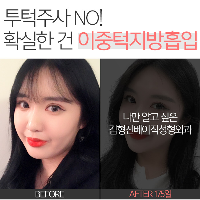 투턱주사 언제까지 맞으려구요? 관련 이미지 7