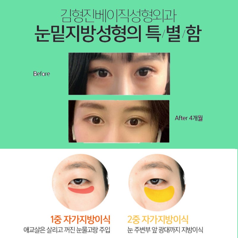 눈밑지방재배치전후만 찾아보고 있다면 관련 이미지 5