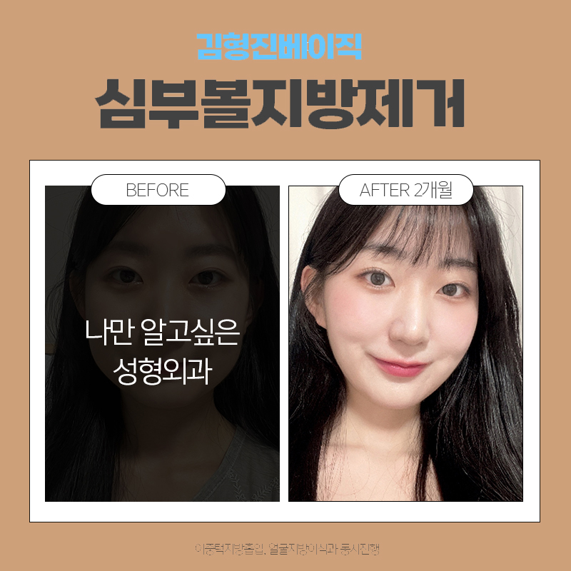볼살제거 하고 V라인 장착하고 왔어요! 관련 이미지 6