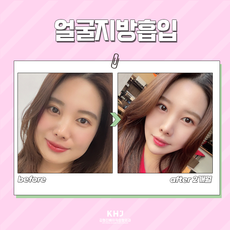 얼굴지방흡입으로 매끈하게 다듬고 싶다면 관련 이미지 6