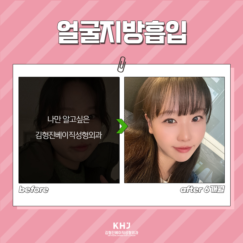 얼굴지방흡입효과 확실한 차이 보고가세요! 관련 이미지 5