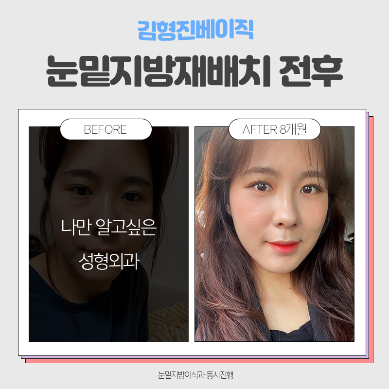 눈밑지방재배치전후 보러오실분 관련 이미지 7