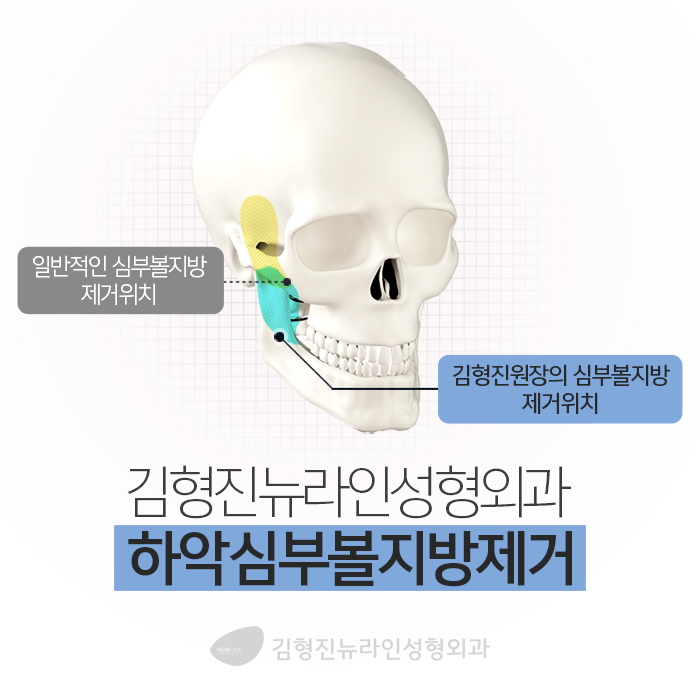 하악심부볼지방제거 보면 놀라요 관련 이미지 4