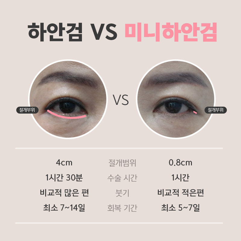 What Is the Difference Between Mini Lower Blepharoplasty and Under-Eye Fat Repositioning? image 4